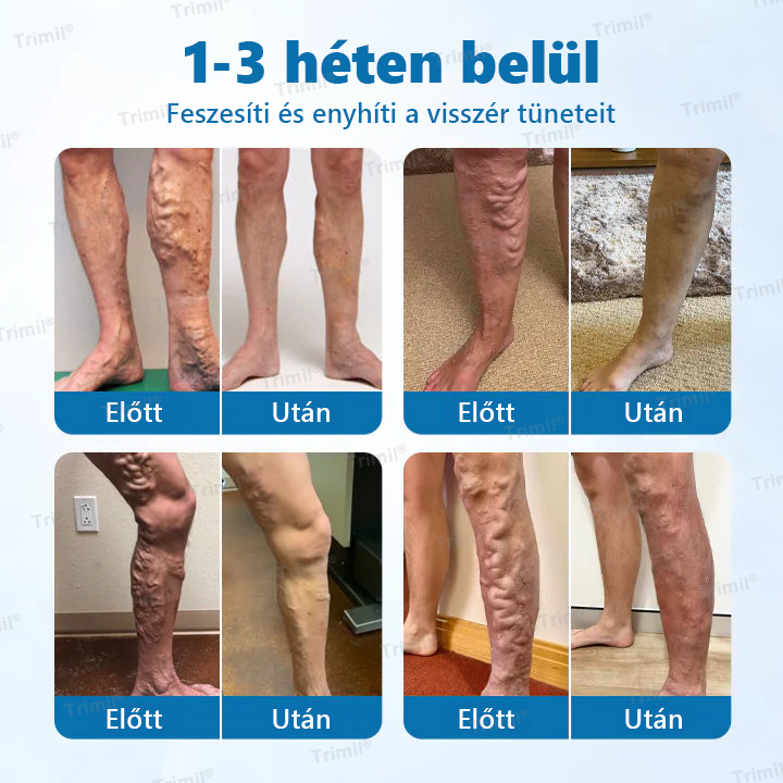 Trimil® VeinGuard Gyógynövényes Spray — ✨Klinikailag bizonyított, hogy mindössze 7 nap alatt megszünteti a visszereket!